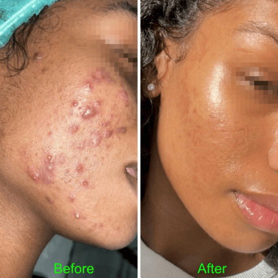 Herbal Peel 3 Treatments Package at ZoGlo Esthetics in Goose Creek, SC